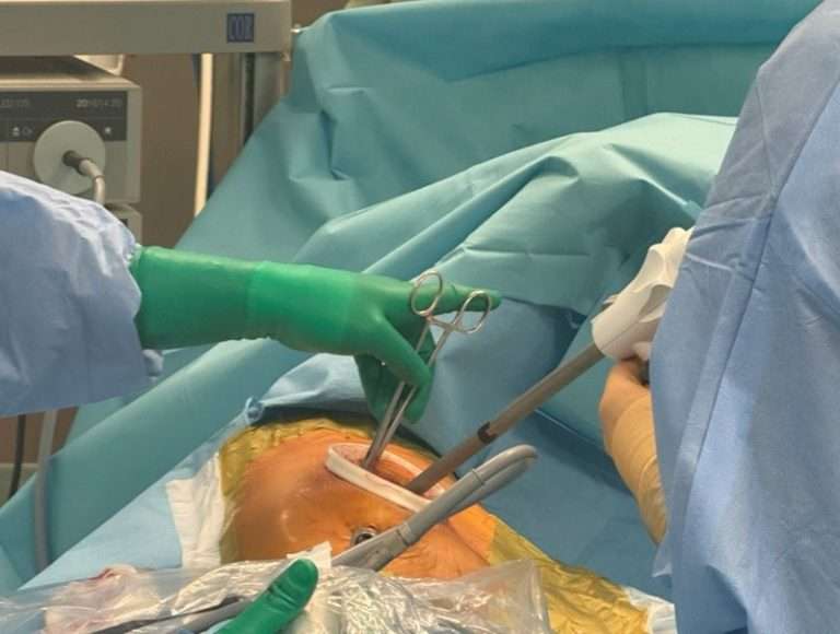 Stapler chirurgiczny elektryczne IREACH Omnia